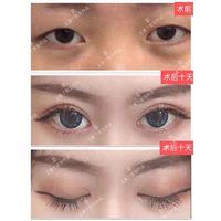 成都正规眼综合整形