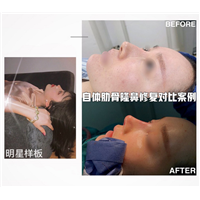 上海杨明肋骨鼻 