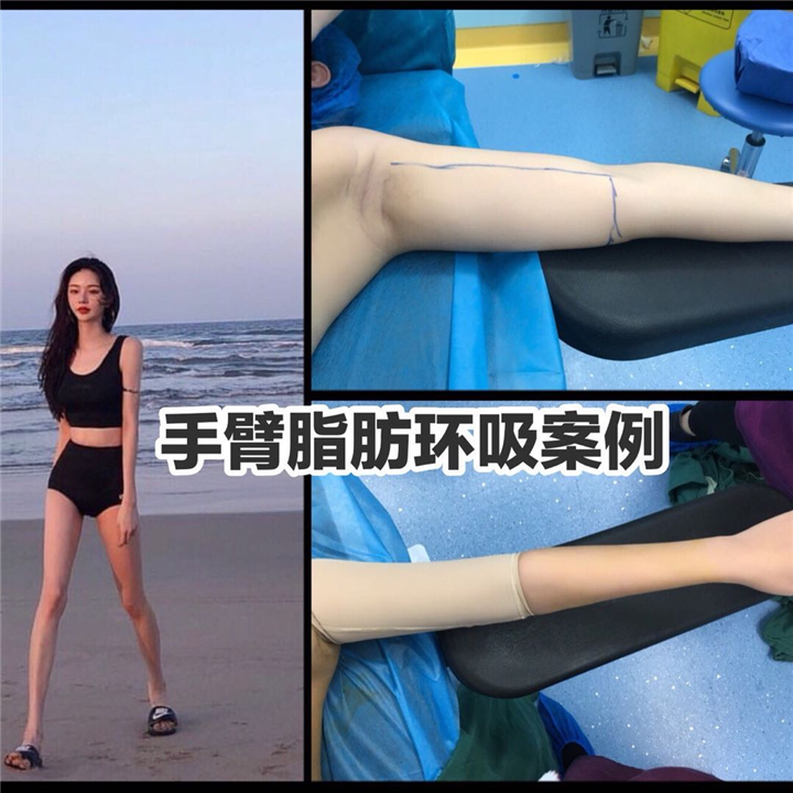 上海手臂吸脂整形 