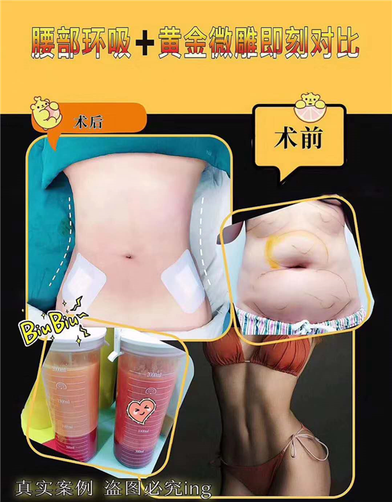 上海吸脂整形 