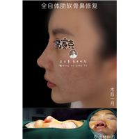 合肥自体肋软骨鼻修复