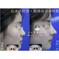 合肥王大勇鼻整形修复
