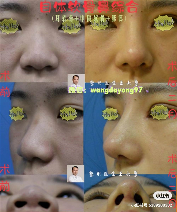 高难度鼻整形修复医生