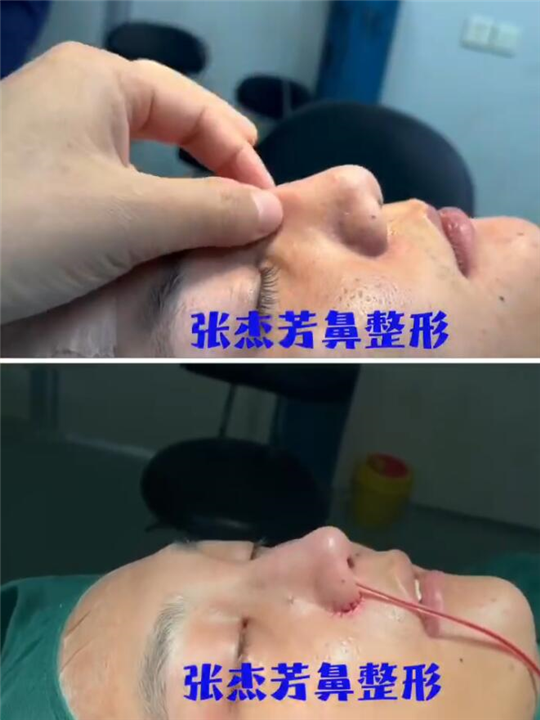 长沙鼻整形修复医生张杰芳