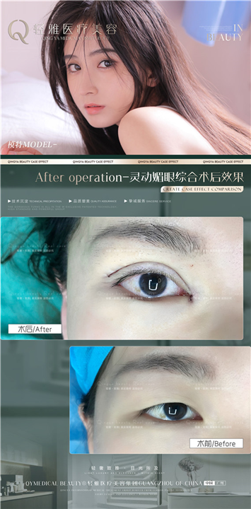 轻雅眼综合整形案例