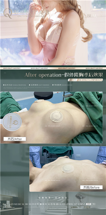 轻雅隆胸整形案例