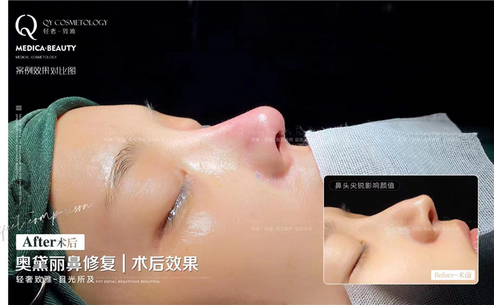 鼻综合整形案例
