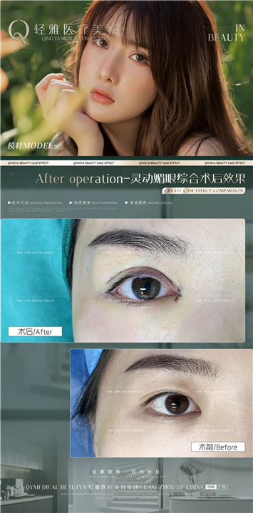 轻雅眼综合整形案例