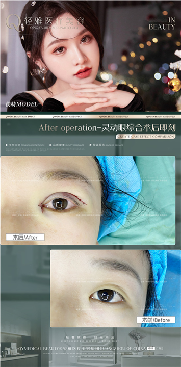 轻雅眼综合整形案例