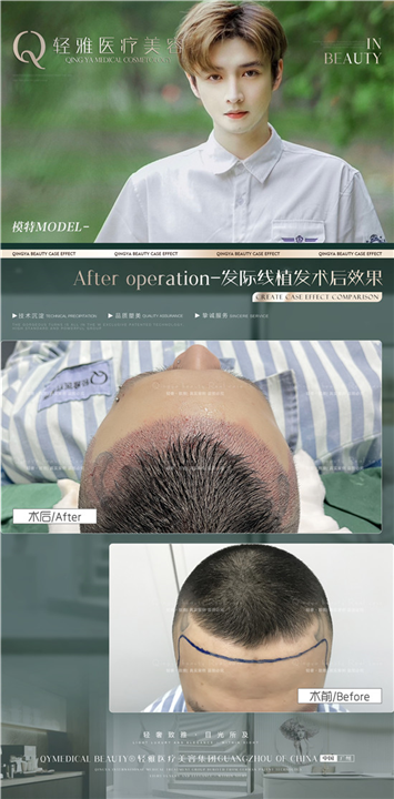 植发整形案例