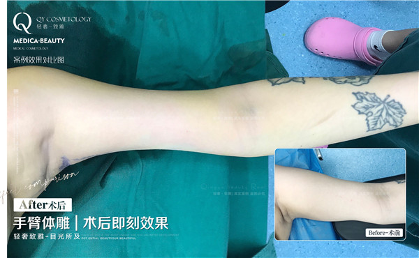 广州手臂体雕整形