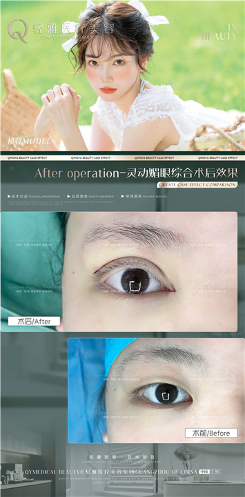 轻雅眼综合整形案例