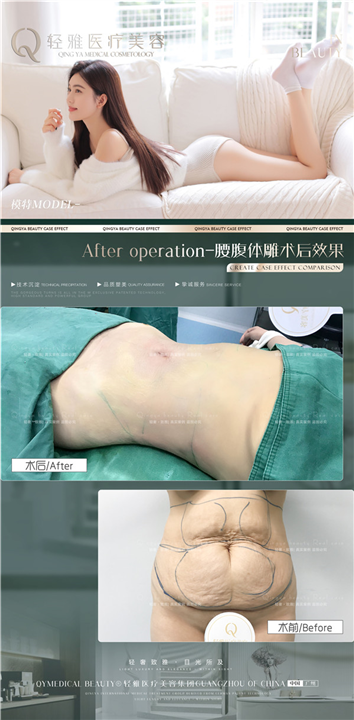 轻雅吸脂瘦身案例