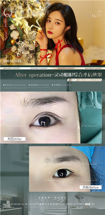 轻雅眼综合整形案例