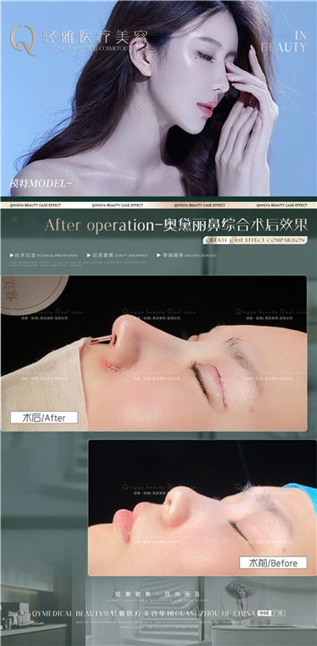 鼻综合整形案例
