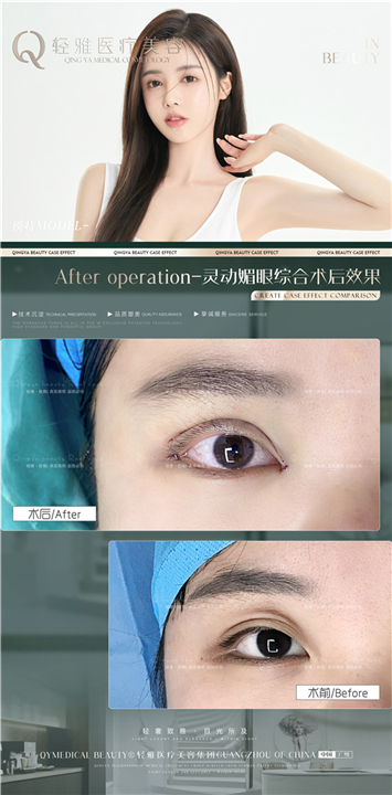 轻雅眼综合整形案例