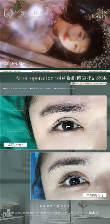 轻雅眼综合整形案例