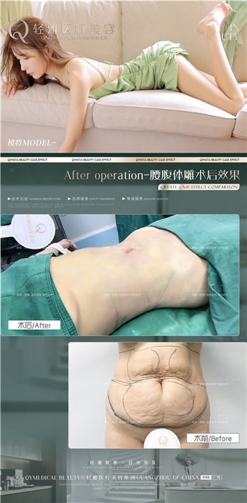 轻雅吸脂瘦身案例