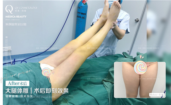 广州轻雅大腿吸脂