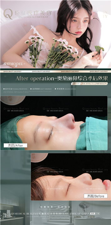 鼻综合整形案例
