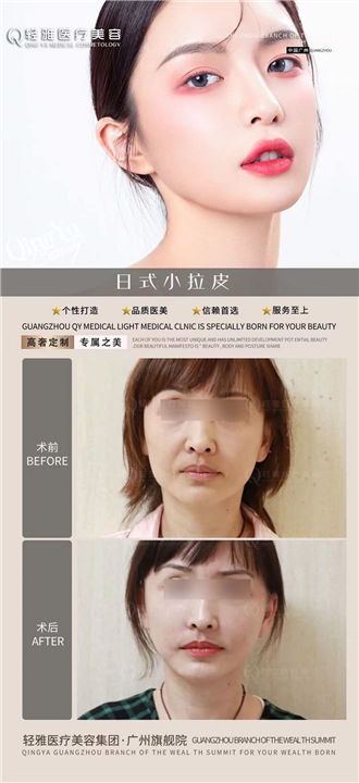 日式小拉皮整形