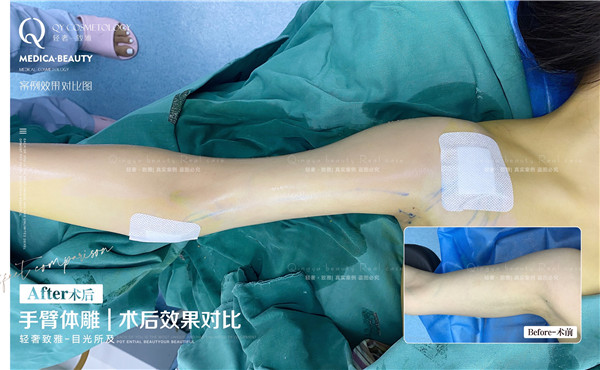 广州手臂体雕整形