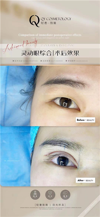 轻雅眼综合整形案例