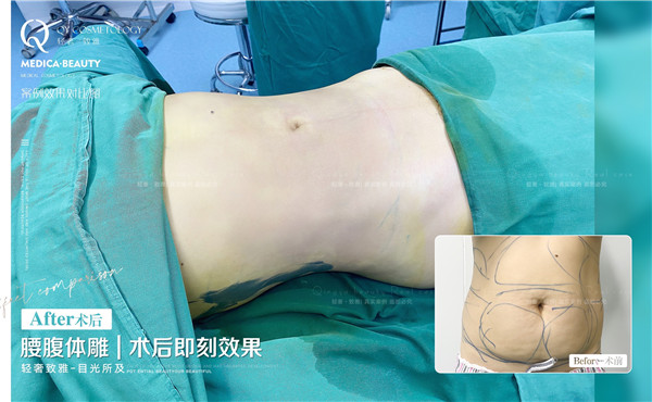轻雅吸脂瘦身案例