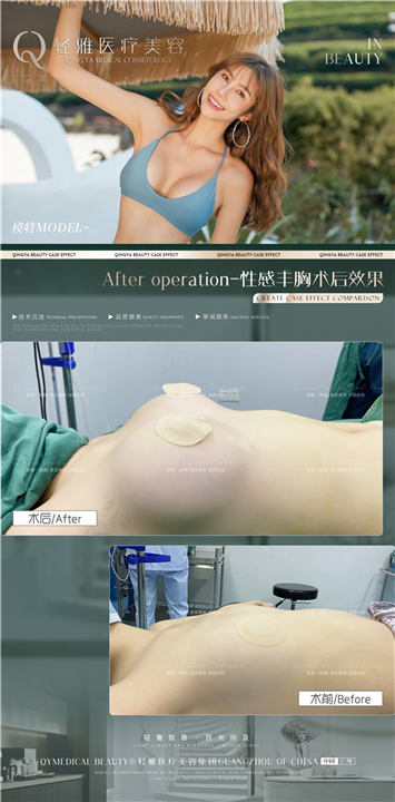 轻雅隆胸整形案例