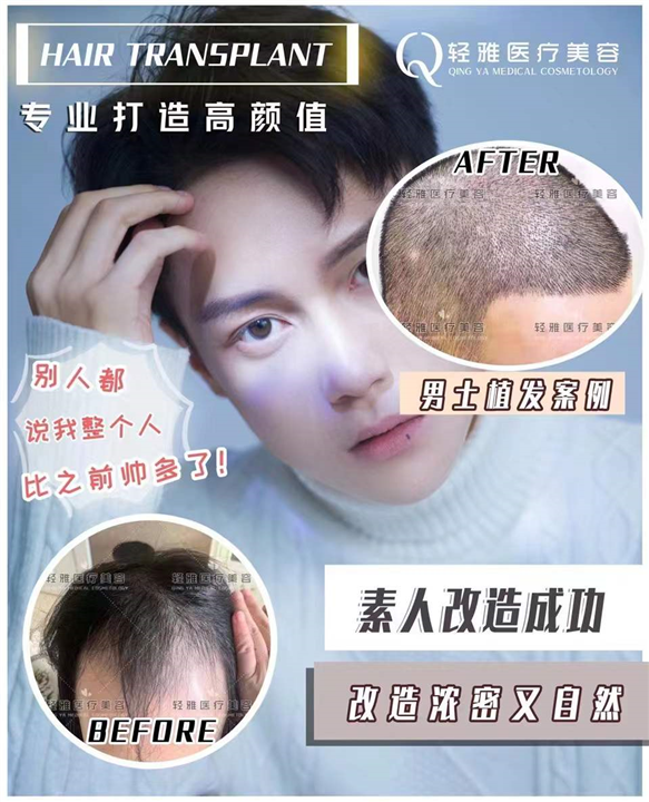 植发整形案例