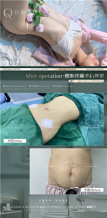 轻雅吸脂瘦身案例