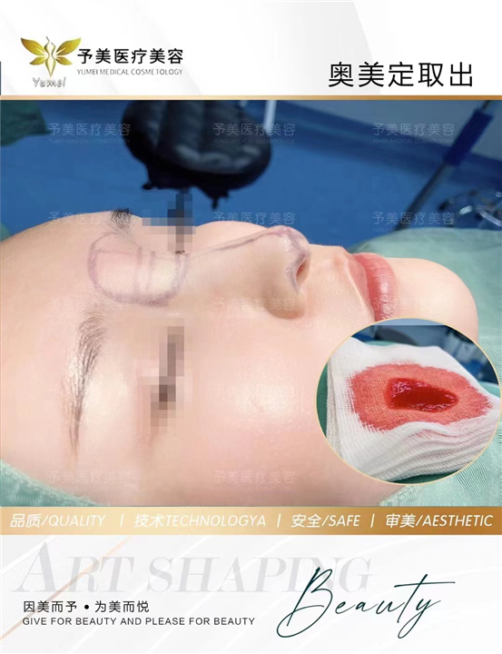 奥美定取出