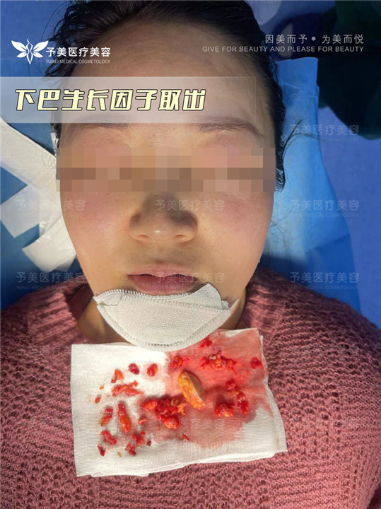 生长因子注射下巴如何修复