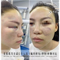 苹果肌生长因子畸形修复