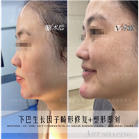 下巴生长因子取出费用