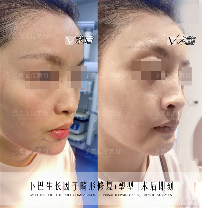 张才医生下巴生长因子取出