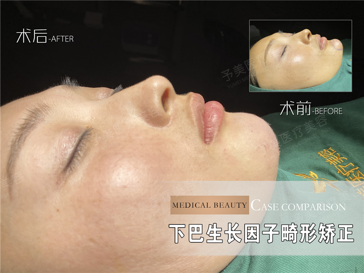 张才医生下巴生长因子取出案例