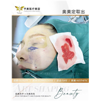 奥美定取出案例