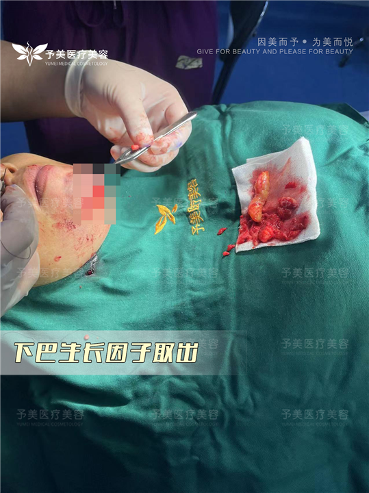 下巴注射生长因子如何取出