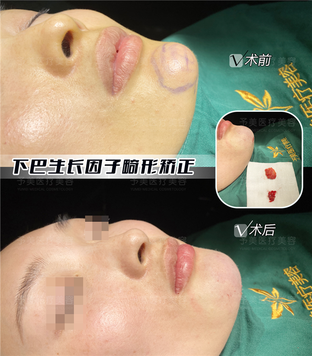 徐州张才医生:下巴生长因子畸形矫正案例