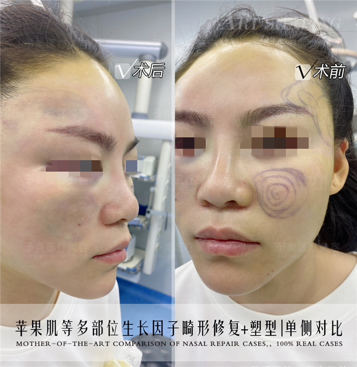 苹果肌生长因子畸形修复