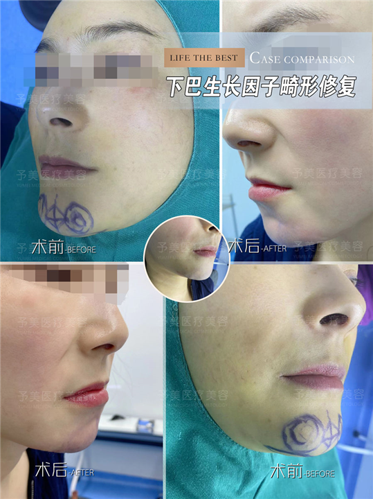 下巴生长因子畸形修复多少钱