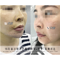 下巴生长因子取出多久才能消肿