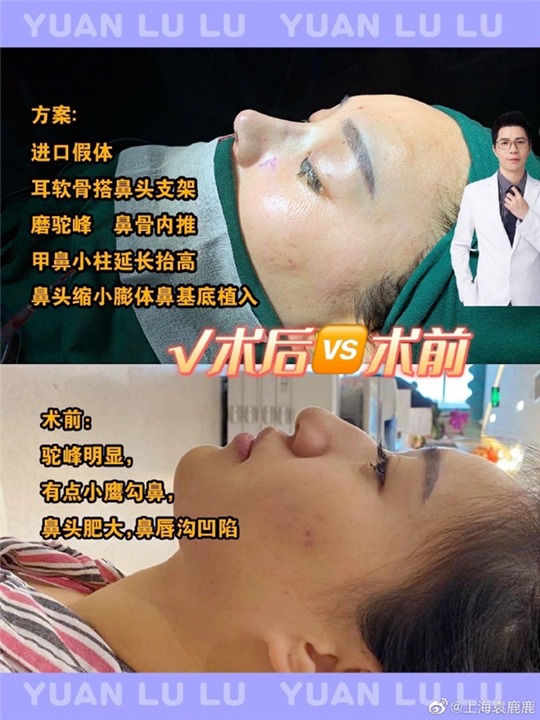 袁鹿鹿鼻整形修复