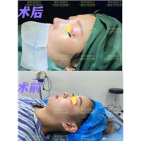 袁鹿鹿做鼻子怎么样