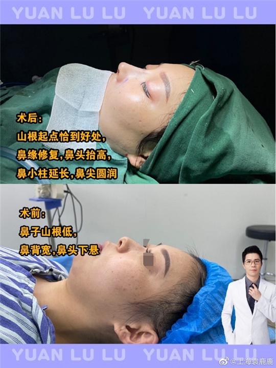 上海鼻整形修复专家