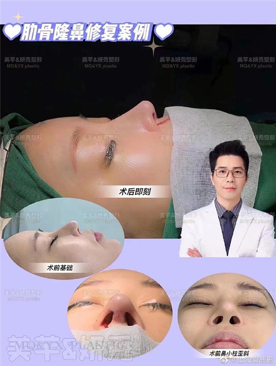 上海肋骨鼻整形医生