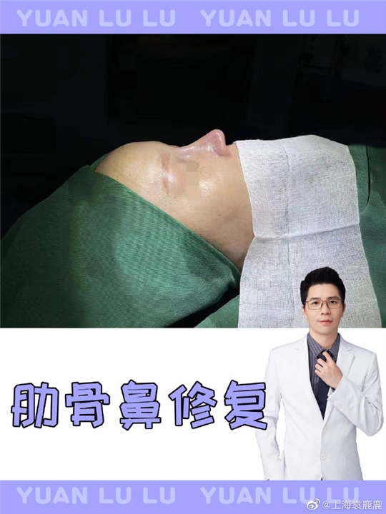 袁鹿鹿做鼻子怎么样