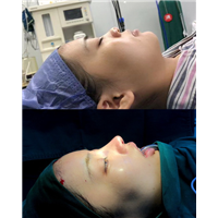 上海鼻整形医生