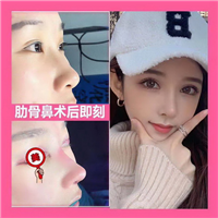 上海隆胸整形